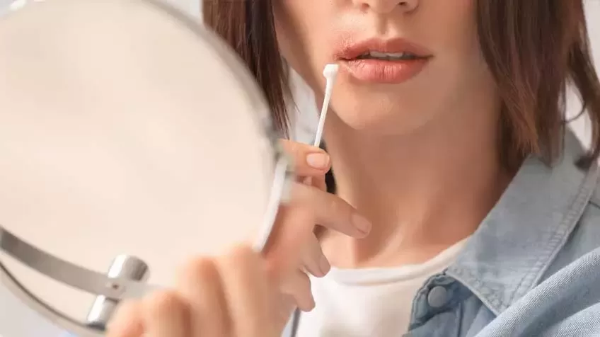 Բերանային հերպես. ինքնօգնություն