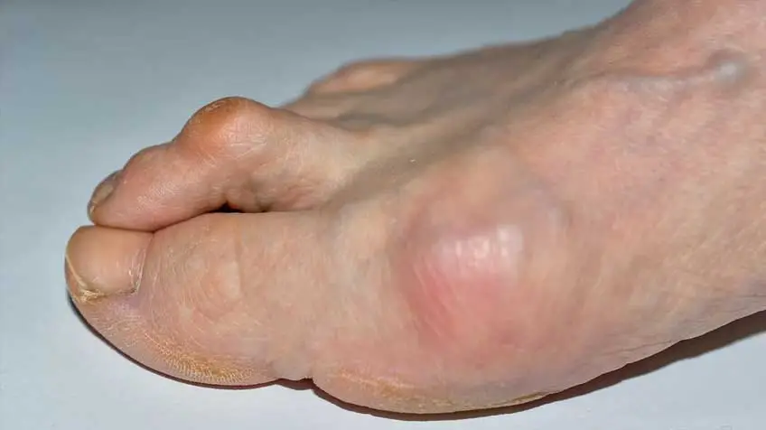 Մրճանման ոտքի մատներ․ ախտանիշներ